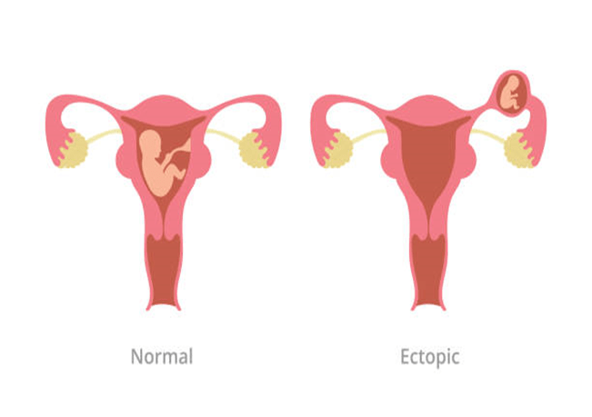 How Common is Ectopic Pregnancy After Tubal Ligation