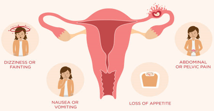 Signs of Ectopic Pregnancy After Tubal Ligation