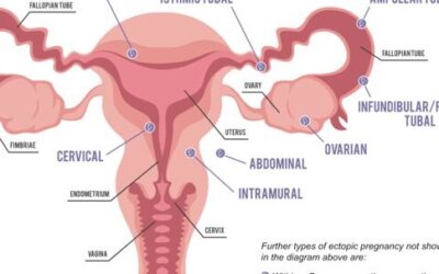 Ectopic Pregnancy – Symptoms and Treatment in Mumbai