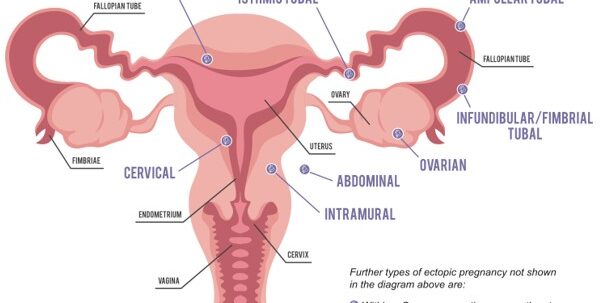 Ectopic Pregnancy – Symptoms and Treatment in Mumbai