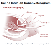 Sonohysterosalpingography 