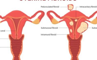 Do Uterine Fibroids affect pregnancy?