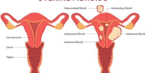 Do Uterine Fibroids affect pregnancy?