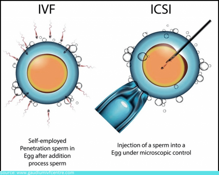 IVF ICSI