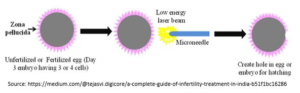 process of Laser Assisted Hatching