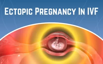 Ectopic Pregnancy In IVF