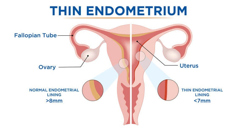 Endometrial  IVF