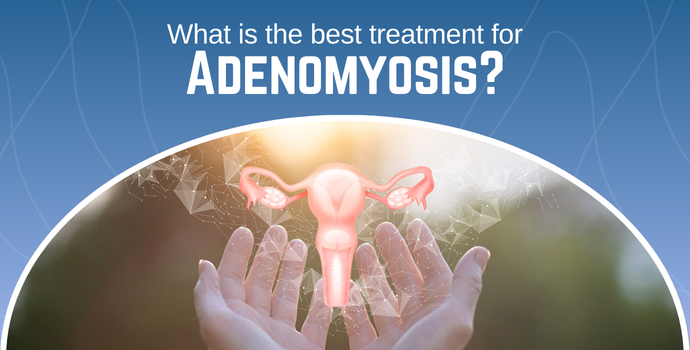 What Is the Best Treatment for Adenomyosis?