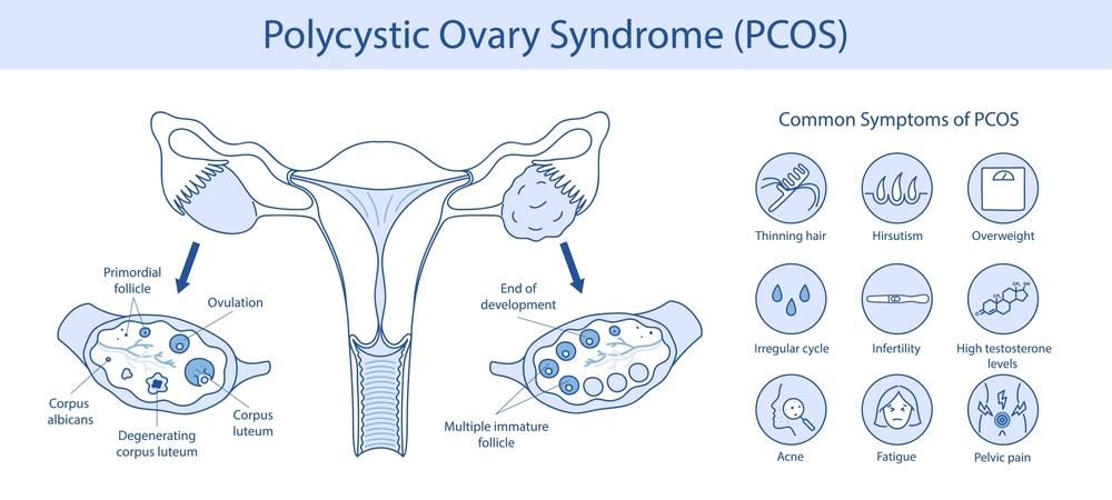 What Is PCOS, Really? What Is PCOS, Really?