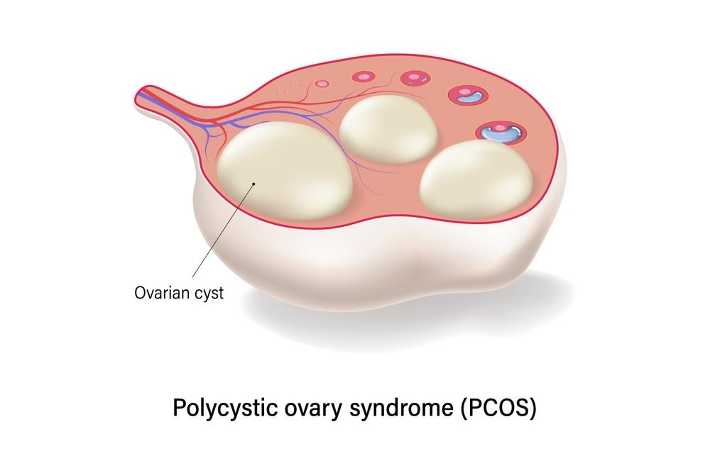 So, Can You Get Pregnant Naturally with PCOS? So, Can You Get Pregnant Naturally with PCOS?