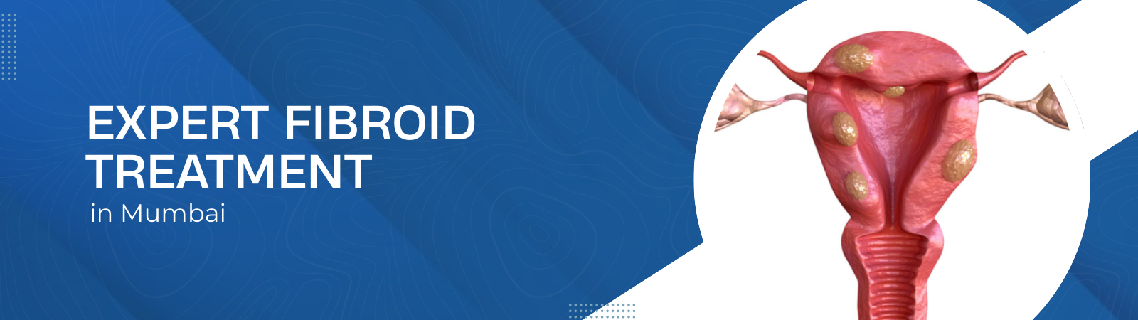 Expert_Fibroid_Treatment_in_Mumbai