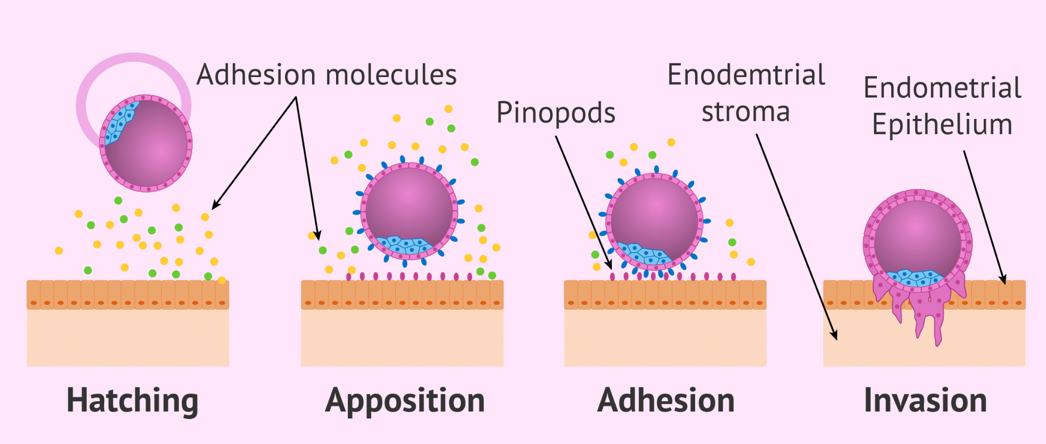 Infographic explaining IVF after hydrosalpinx removal: left panel shows steps from ovarian stimulation to embryo transfer, center shows uterus with embryo implantation, right highlights key points.